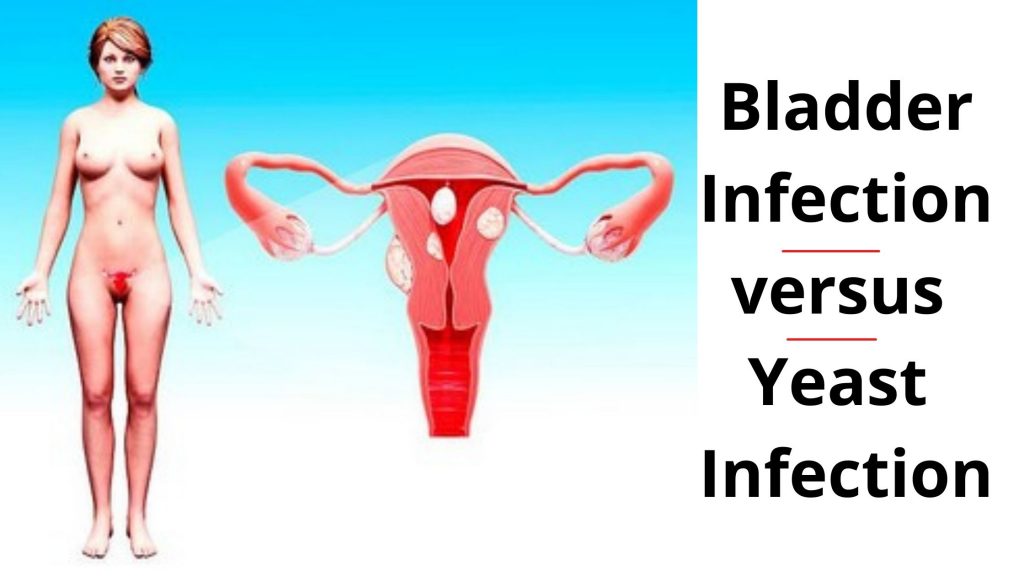 Bladder Infection versus Yeast Infection