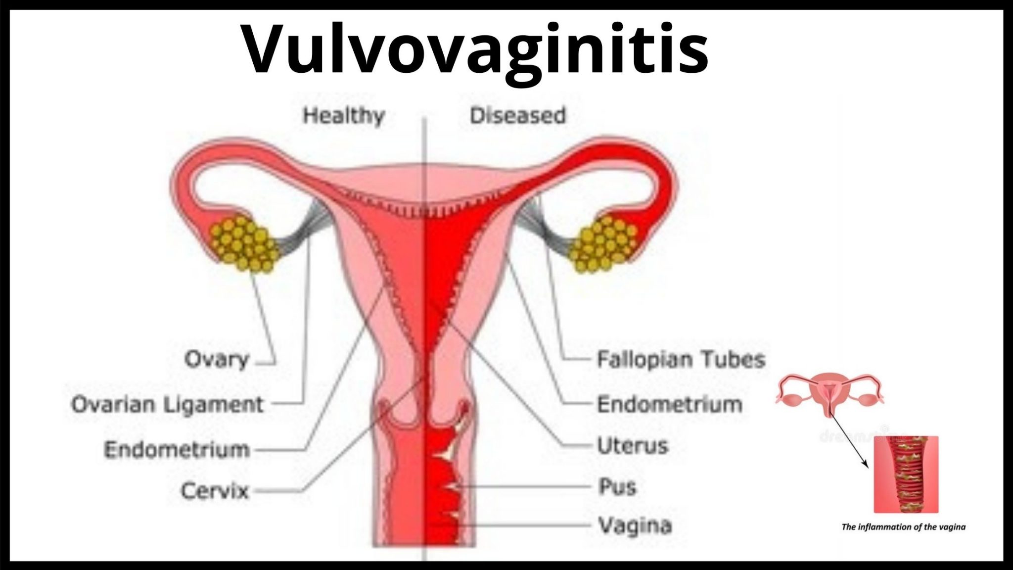 vulvovaginitis-vs-yeast-infection-symptoms-treatment-needed