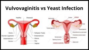 Vulvovaginitis vs Yeast Infection