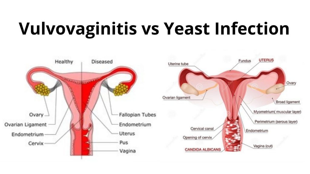 Vulvovaginitis vs Yeast Infection