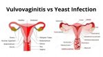 Vulvovaginitis vs Yeast Infection: Symptoms & Treatment Needed