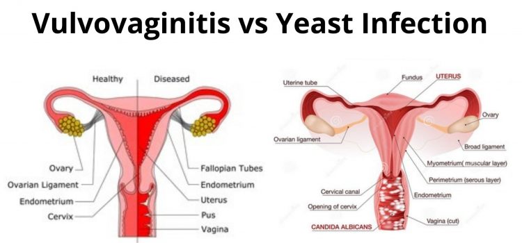 Vulvovaginitis vs Yeast Infection