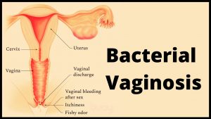 Bacterial vaginosis