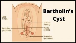 Bartholin’s Cyst