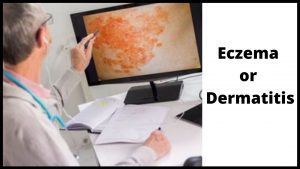 Eczema or dermatitis
