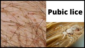 Pubic lice