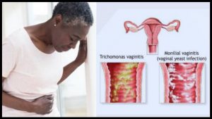 Trichomoniasis