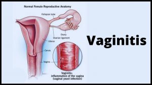 Vaginitis