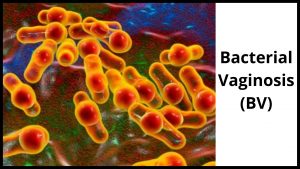  Bacterial vaginosis (BV)