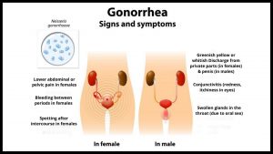 Gonorrhea