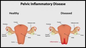 Pelvic inflammatory disease