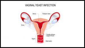 Yeast infection