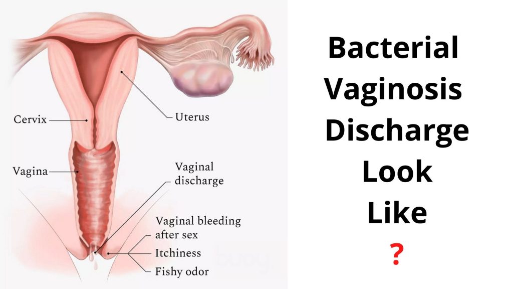 Bacterial Vaginosis Discharge Look Like