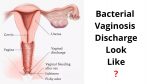 Bacterial Vaginosis Discharge Look Like? Here is It!
