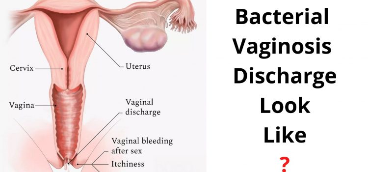 Bacterial Vaginosis Discharge Look Like