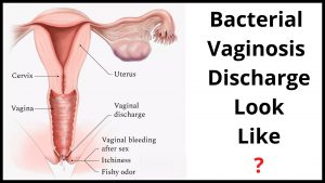 Bacterial Vaginosis Discharge Look Like
