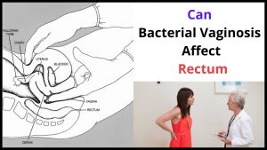 Can Bacterial Vaginosis Affect Rectum