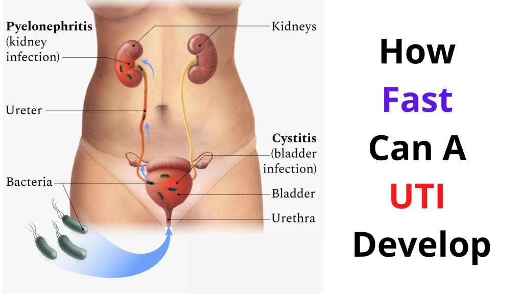How Fast Can A UTI Develop