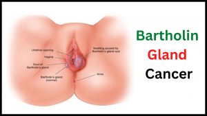 Bartholin Gland Cancer