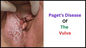 Paget’s Disease Of The Vulva