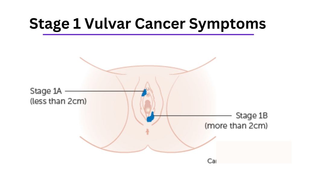 Stage 1 Vulvar Cancer Symptoms
