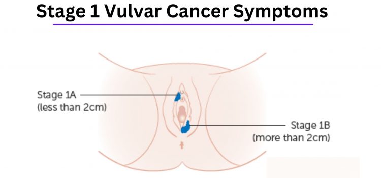Stage 1 Vulvar Cancer Symptoms
