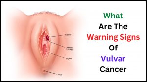 What Are The Warning Signs Of Vulvar Cancer 