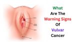 What Are The Warning Signs Of Vulvar Cancer – Ultimate Guide
