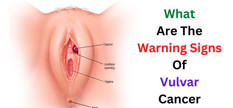 What Are The Warning Signs Of Vulvar Cancer