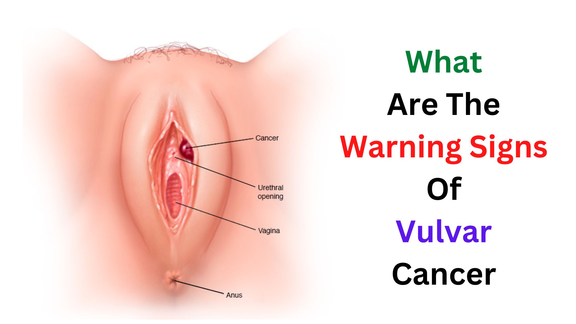 What Are The Warning Signs Of Vulvar Cancer – Ultimate Guide