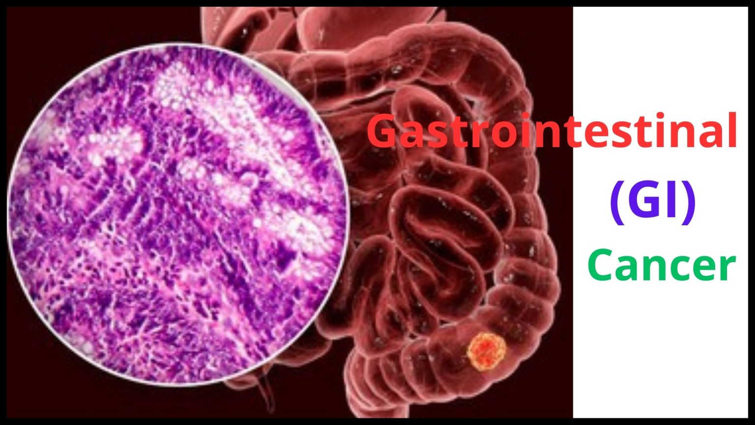Can Cancer Cause Yeast Infections? The TRUTH!