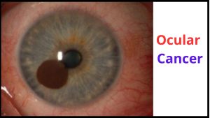 Ocular cancers